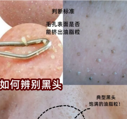 黑头多的原因,脸上有黑头是什么原因
