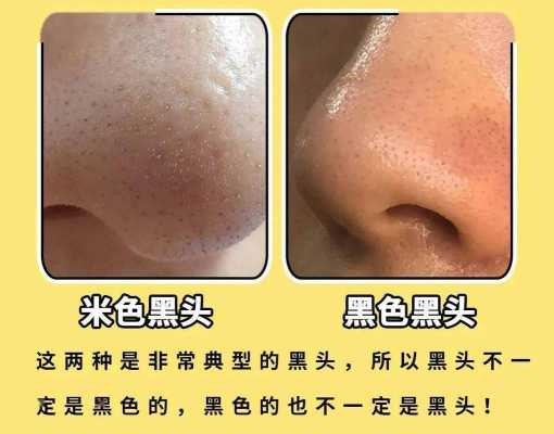 黑头多的原因,脸上有黑头是什么原因