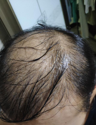 为什么头发容易出油（头发上面老是出油是什么病吗）