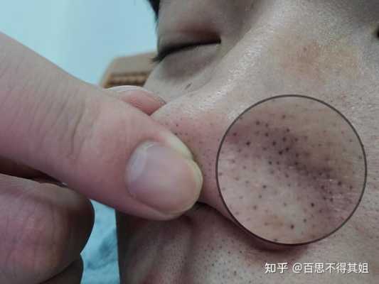 鼻子上长黑头怎么办,鼻子黑头怎么治疗最有效