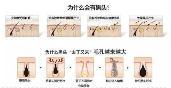 黑头怎么快速消除（黑头怎么快速消除小妙招）