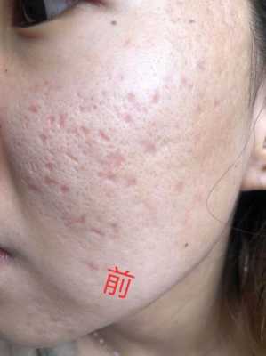 小痘坑怎么修复（小痘坑怎么修复简单方法）