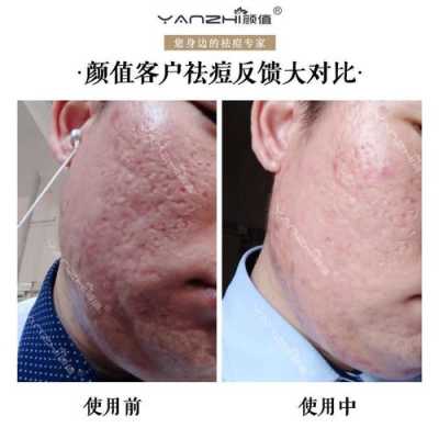小痘坑怎么修复（小痘坑怎么修复简单方法）