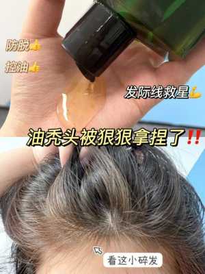 掉头发头发出油怎么办（掉头发头发出油怎么办啊）