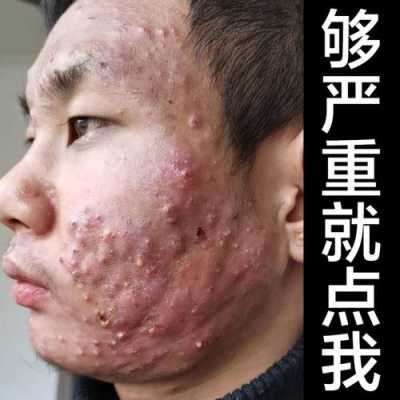 怎么清除青春痘（怎么清除青春痘男）