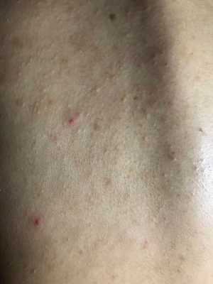 脸上长粉刺怎么治（脸上背部长痘痘，怎么治疗）