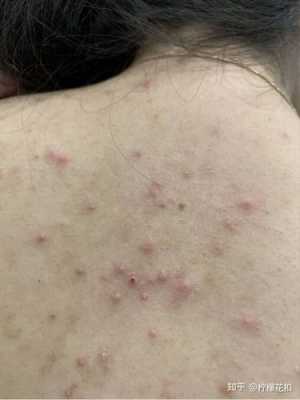 脸上长粉刺怎么治（脸上背部长痘痘，怎么治疗）