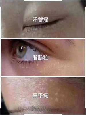 皮肤有脂肪粒怎么办（男性根茎表皮长了脂肪粒怎么办）