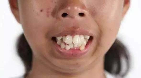 龅牙适合什么发型（龅牙适合什么发型男）