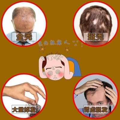 掉发怎么治疗,脱发掉发怎么治疗要用什么药