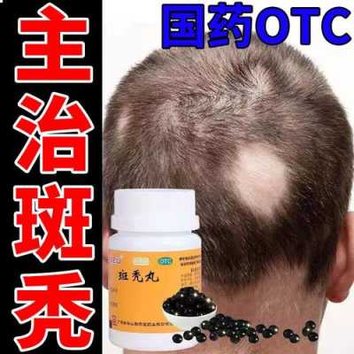 掉发怎么治疗,脱发掉发怎么治疗要用什么药