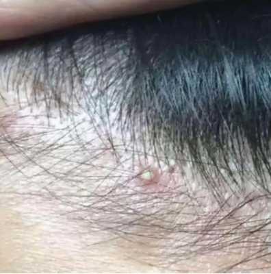 为什么头皮上长痘痘（为什么头皮上长痘痘和脓包）
