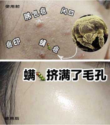 黑头粉刺毛孔粗大怎么去除最有效,黑头粉刺毛孔粗大怎么去除最有效