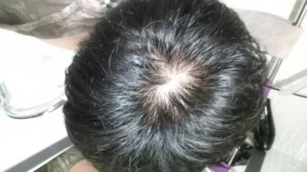 头皮痒掉头发怎么办,头皮受损脱发怎么办呢