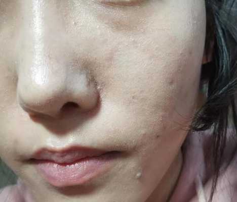 化妆时脸上起皮怎么办（化妆了脸上脱皮怎么急救）