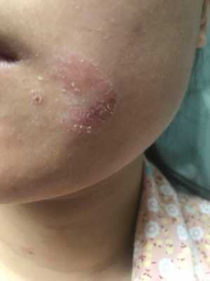 化妆时脸上起皮怎么办（化妆了脸上脱皮怎么急救）