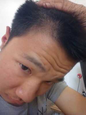 头发细软少是什么原因（额头两侧头发细而且少，中间头发厚两侧薄）