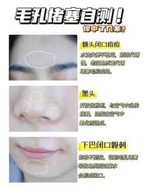 有黑头了怎么办（黑头粉刺怎么办）