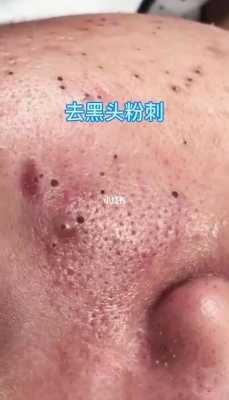 有黑头了怎么办（黑头粉刺怎么办）