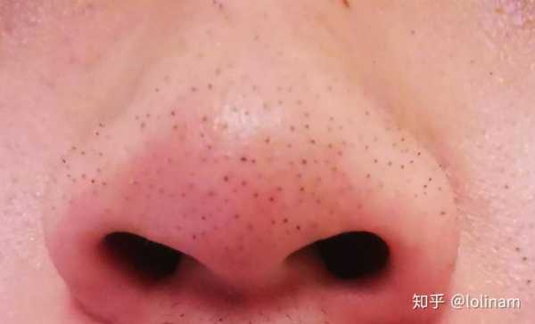 鼻子上为什么会有黑头（为什么化妆后黑头会浮出来）