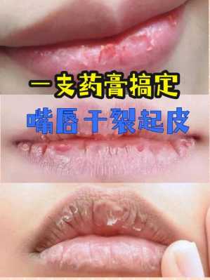 嘴唇起皮怎么办小妙招（嘴唇起皮怎么办小妙招图片）