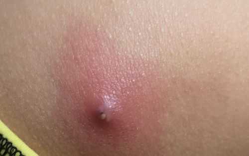 屁股上长了痘痘怎么治疗,痘痘怎么才能快速消除