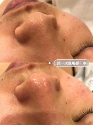 去黑头怎么去（怎么去黑头的方法）