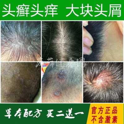 头皮痒得难受，油特多是什么原因,头皮屑多头皮痒是什么原因用什么药
