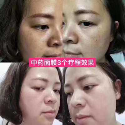 用中药祛斑怎么样,愉心堂美白祛斑怎么样