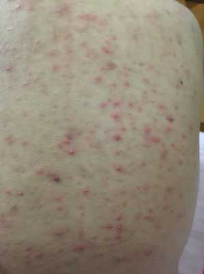 后背长很多痘痘是什么原因（男人后背长很多痘痘是什么原因）