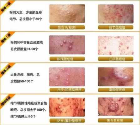 青春痘怎么（青春痘怎么）