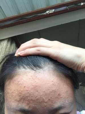额头长了很多小疙瘩怎么办,额头长怎么办发型