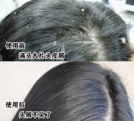 头屑怎么办（冬天有头屑怎么办）
