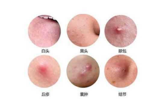 粉刺怎么去（去粉刺最好的方法）