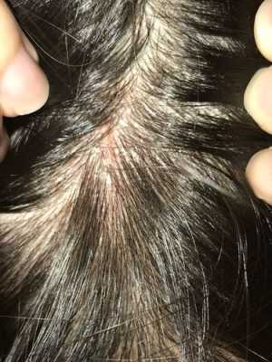 头上痒怎么办（头上痒怎么办越挠越痒,特别是晚上）