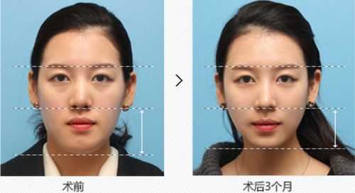 长脸怎么办（长脸怎么调整脸型）