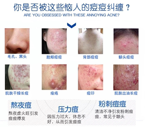 脸上粉刺怎么办（脸上粉刺怎么办去除）