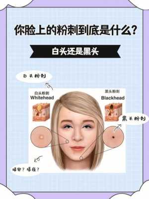 白头粉刺怎么（怎么刮白头粉刺）