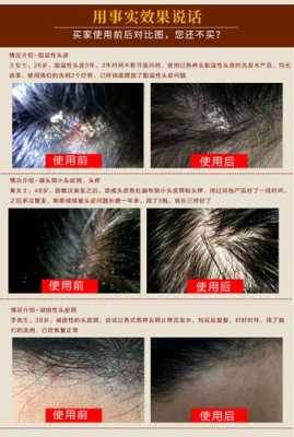 什么去头皮屑（如何正确洗头才能去除头皮屑）