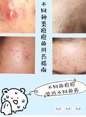粉刺该如何去除,怎么消除粉刺最快最有效