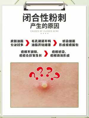 粉刺该如何去除,怎么消除粉刺最快最有效