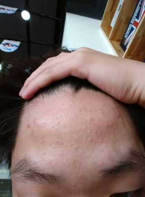 起粉刺怎么办（脸上起粉刺怎么办）