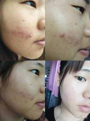 皮肤长痘痘怎么办（脸上长痘痘该怎么去除）
