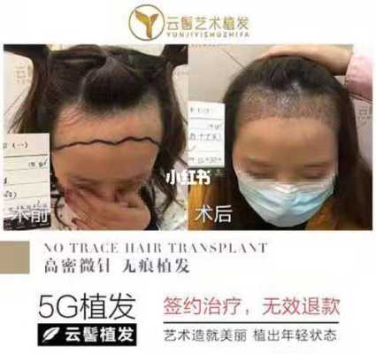 怎么种好头发,头发怎么种植视频
