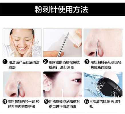 去黑头什么好用（去黑头是用粉刺针还是棉签）