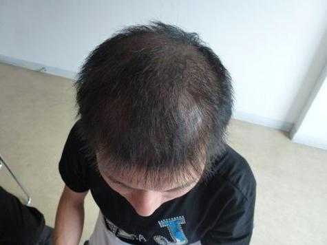 脱发严重什么原因,严重脱发什么原因造成的
