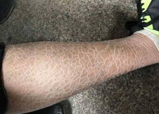 皮屑多是什么原因（皮屑多是什么原因引起的）