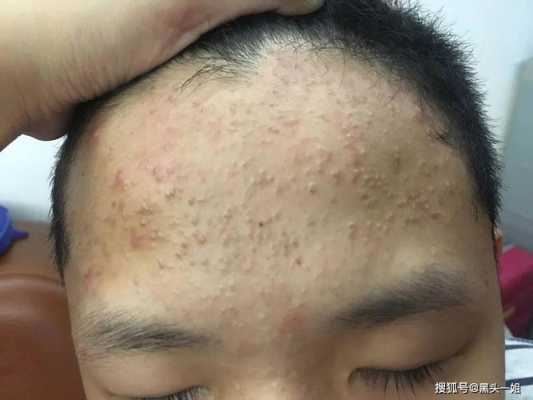 闭口痘痘是什么（闭口粉刺什么样子）