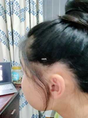 不长头发是怎么回事,头发为什么不长的原因