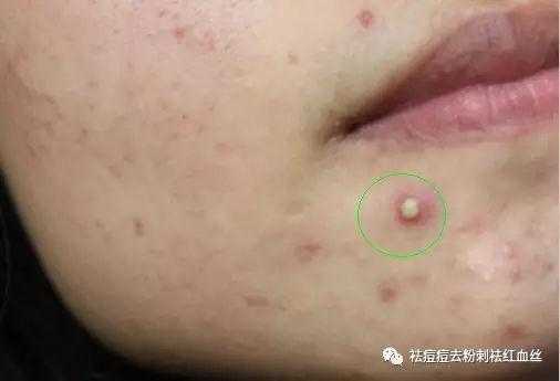 白头粉刺怎么办（女性阴部长白头粉刺怎么办）